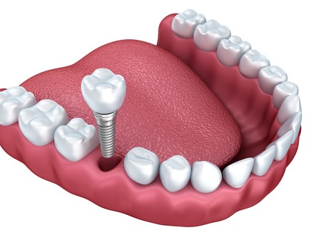 Implant Restoration