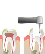 root-canal